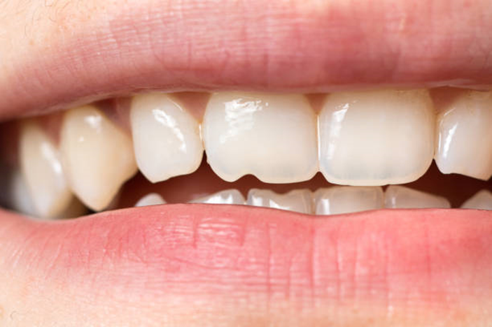 Dente quebrou ou trincou? O que fazer nos primeiros minutos para salvar o sorriso?