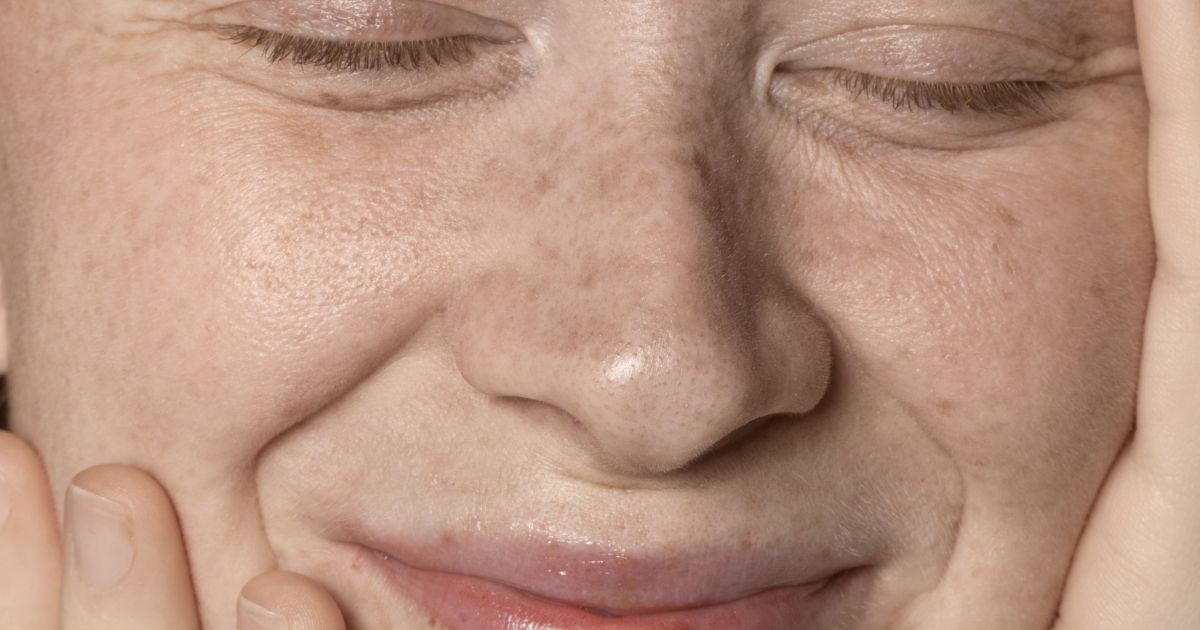Melasma: quais produtos são indicados para o problema