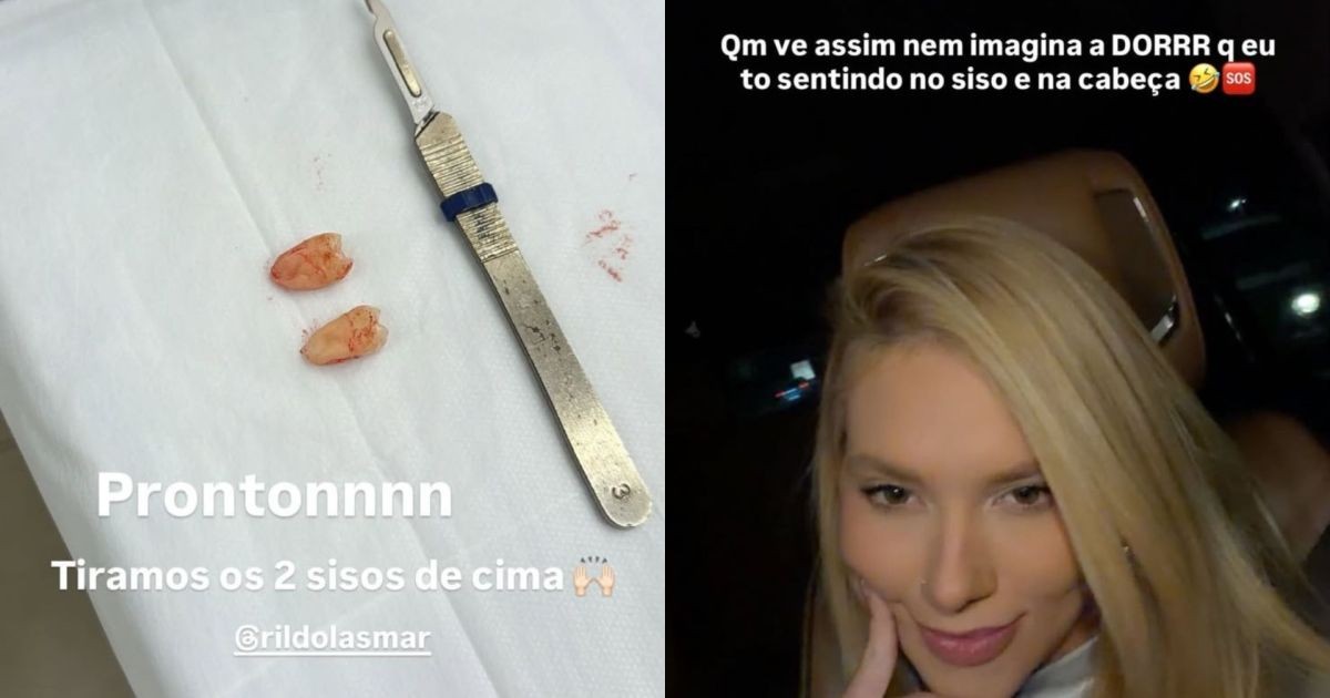 Virginia Fonseca: especialista explica procedimento de extração dos sisos