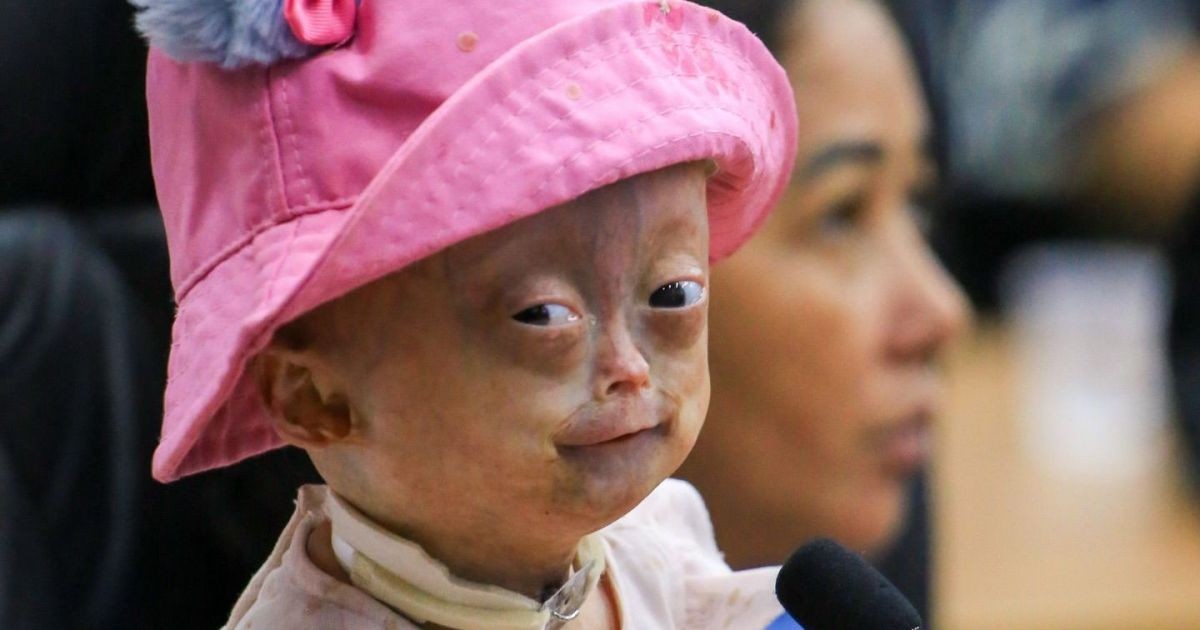 Morre Elis, influenciadora com síndrome da velhice precoce, aos 5 anos