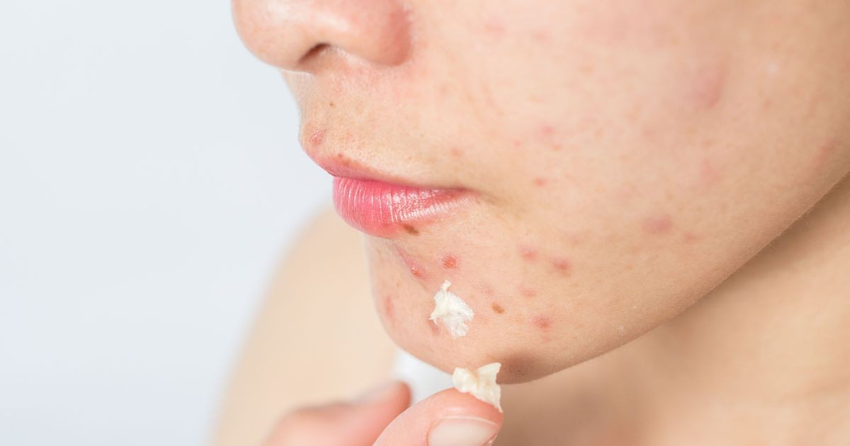 Dados mostram que 45% do jovens usam o Tiktok para tirar dúvida sobre acne
