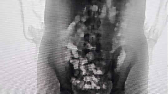 Adolescente tenta entrar em presídio com 32 porções de droga no corpo em SC