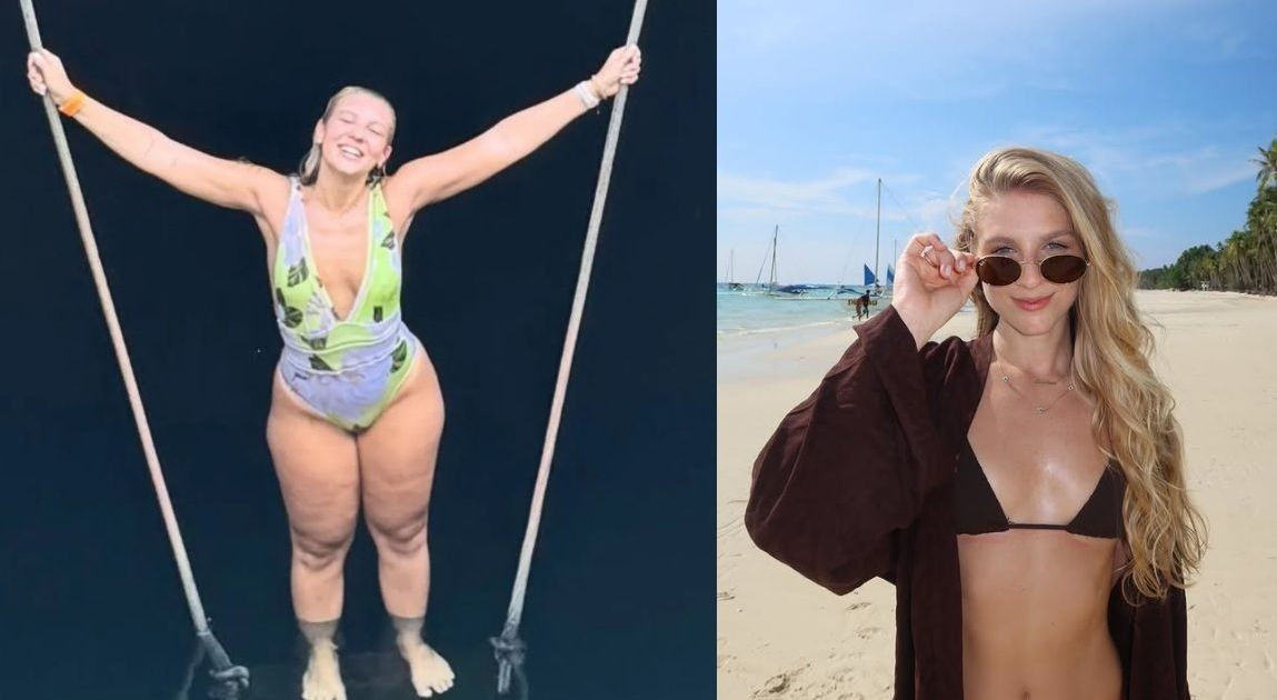 Lauren Pfeiff relata um ano de cirurgia de lipedema: “Impacto positivo”