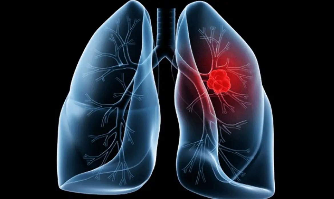 Saiba o que é adenocarcinoma pulmonar, câncer que atinge o Papa Leão 