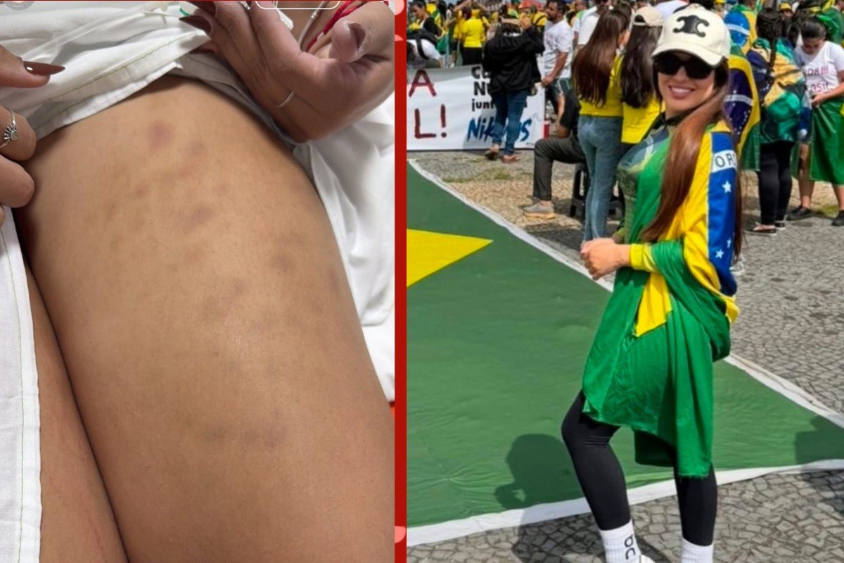 'Levei choque no peito e só tremia', relata empresária de Cuiabá atingida por raio antes de ato pró-Bolsonaro no DF